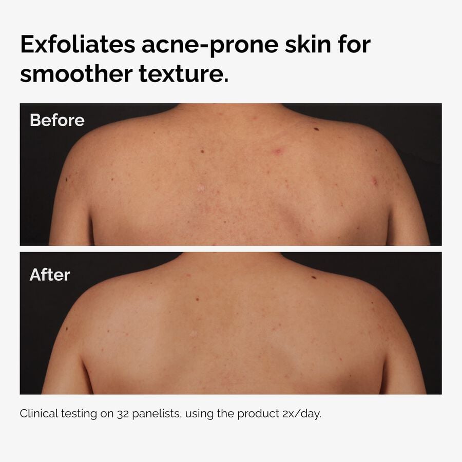 the-body-care-collection-k5 ord-salicylic-acid-body-serum-before-after-graphic-NA.jpg