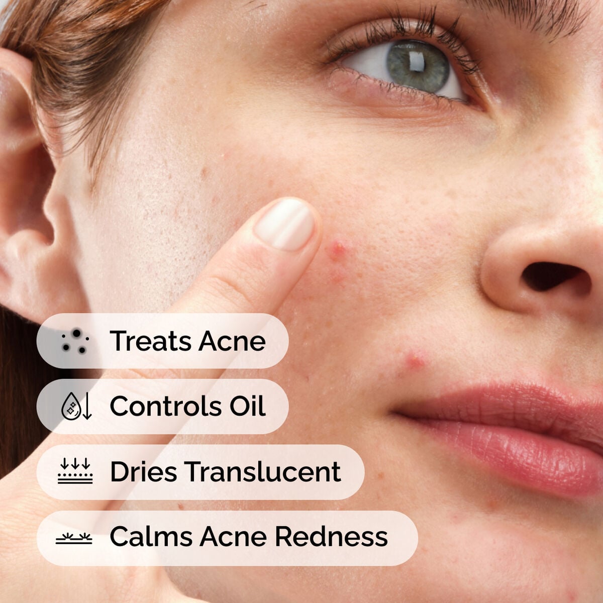 sulfur-10-powder-to-cream-concentrate-h6 ord-sulfur-10pct-powder-to-cream-concentrate-model-application-with-benefits-acne.jpg